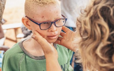 Consultation et Achats de médicaments pour les enfants Albinos – Janvier 2022